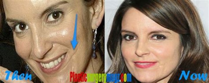 How Did Tina Fey Get Her Scar on Her Face?