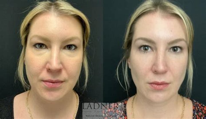 
Lindsey Married At First Sight Plastic Surgery | Before And After Photos 