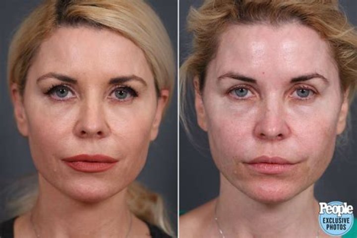 
Sara Platt Turkey Surgery Gone Wrong: Before And After Photo 