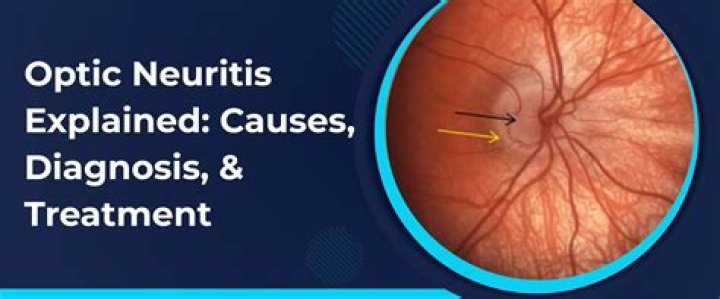 
What is optic neuritis? GoFundMe for Jehane Thomas raises over £10,500 after TikToker’s unexpected death 